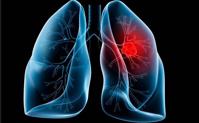 New Device Pledges To Find Lung Cancer In Its Early Stages